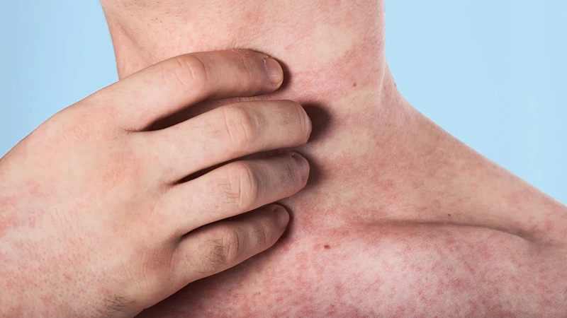 SHA warns of additional measles exposure risks in six communities ...